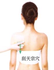 急性乳腺炎刮痧