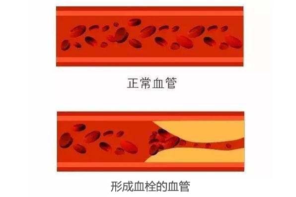 正常血管 与有血栓血管对比